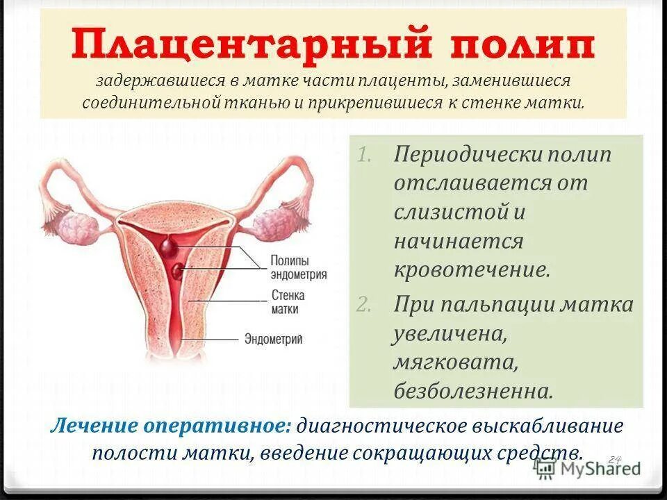 При полипе можно забеременеть. Плацентартарный полип. Плацентарный полип в матке. Хориальный полип эндометрия. Полип в эндометрии матки.