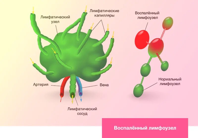 Причины увеличения лимфатических узлов. Воспаление лимфатических узлов. Лимфатические узлы спереди. Увеличенные лимфатические узлы. Воспаленный лимфатический узел.