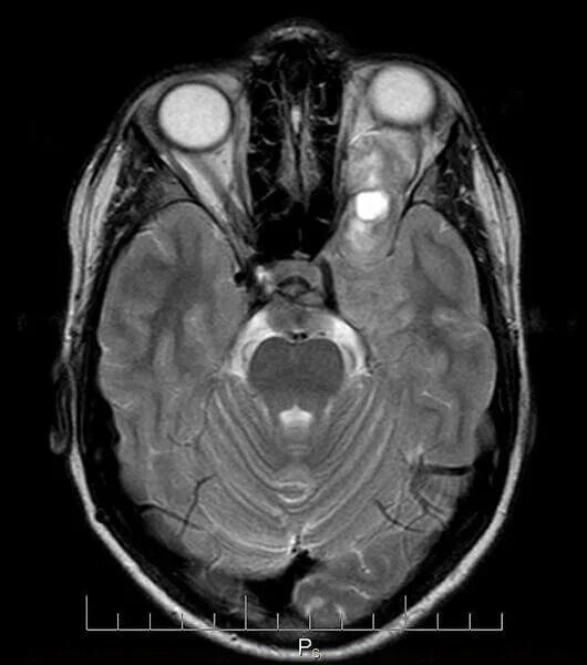 Мрт глазного нерва. Менингиома зрительного нерва мрт. Менингиома зрительного нерва кт. Глиома зрительного нерва мрт. Мрт орбит и зрительных нервов.