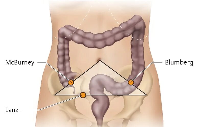 Точки аппендицита. Точка МАКБЕРНИ аппендицит. Точка Ланца и Мак Бурнея. Точка Мак Бурнея при аппендиците.