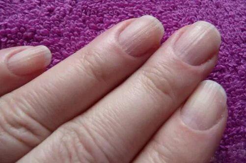 Микотическая лейконихия. Ониходистрофия койлонихия. Почему ногти на руках плоские стали. Типы и формы ногтевых пластин. Деыормация ногтеврй поасиины.