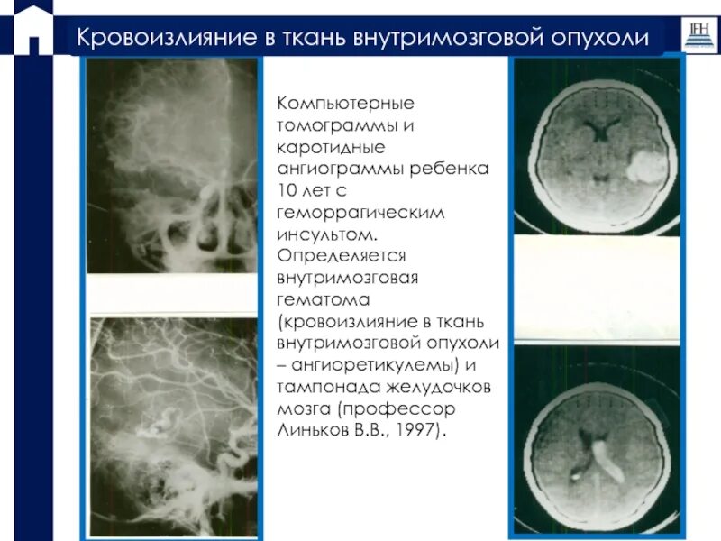 Геморрагический инсульт ангиография. Внутримозговое кровоизлияние гематома. Классификация внутримозговых кровоизлияний. Внутримозговые гематомы классификация. Кровоизлияние в желудочки