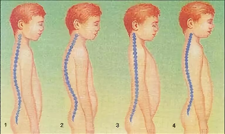 Осанка ребенка 3 года. Правильная осанка у детей. Осанка ребенка 3 года. Формирование неправильной осанки. Осанка у детей.
