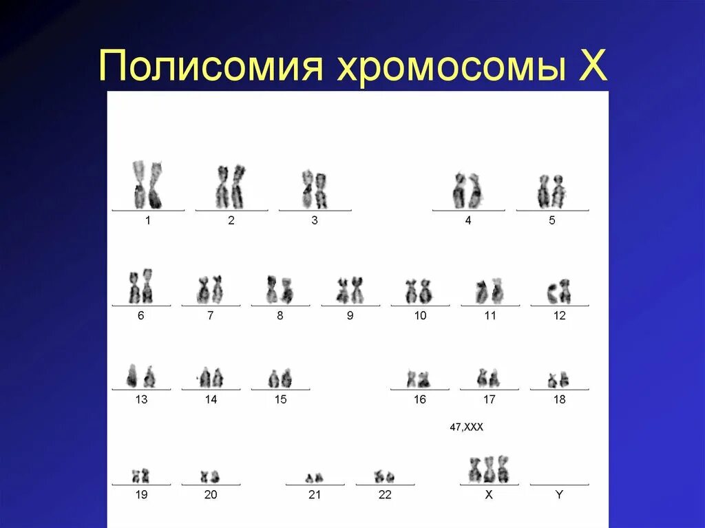 Трипло х. Синдром полисомия по х-хромосоме. Синдром полисомии х-хромосомы кариотип. Полисомия по y-хромосоме синдром. Синдром полисомии по х-хромосоме кариотип.