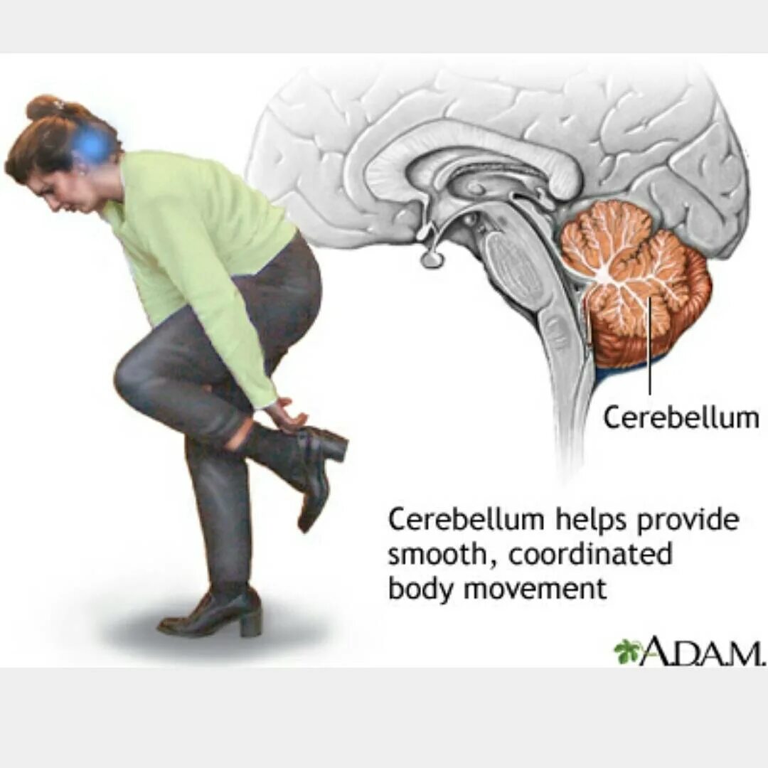 восстанавливается мозжечок. симптомы мозжечкового поражения. транзиторная ишемическая атака головного мозга. мозжечок координация движений. травма мозжечка последствия.
