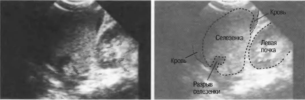 Подкапсульный разрыв селезенки на УЗИ. УЗИ картина травмы селезенки. УЗИ картина при разрыве селезенки. Распад селезенки