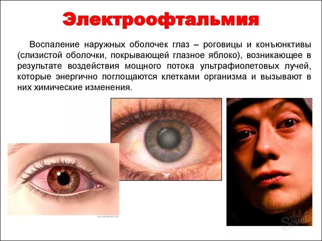 Чайные пакетики на глаза от сварки. Картошка для глаз после сварки. Капли в глаза от сварки от ожога. Капли от ожога глаз. Капли глазные после сварки глаза.