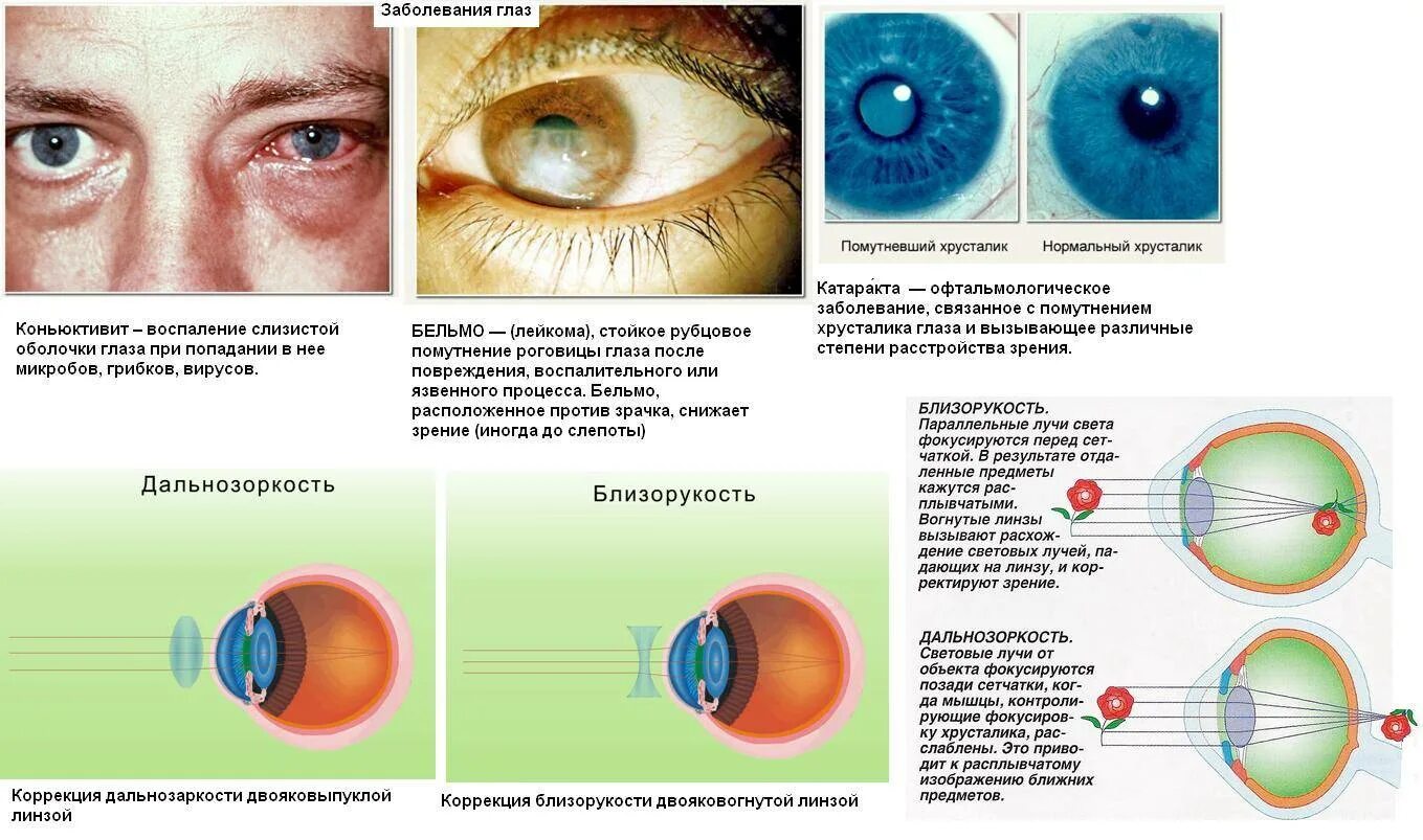Глазное зрение 1. Глазные болезни катаракта таблица. Нарушение органов зрения. Заболевания органов глаз. Заболевания глаз у человека.
