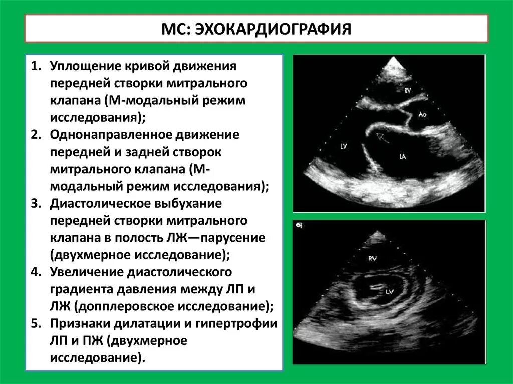 Митральный клапан ЭХОКГ. Створки митрального клапана на ЭХОКГ. Митральный стеноз ЭХОКГ. Створки аортального клапана на ЭХОКГ.