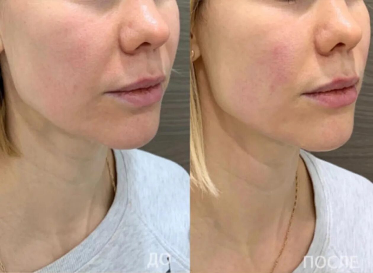 смас москва отзывы. фейслифтинг нижней трети лица фото. смас москва отзывы. смас лифтинг до и после. смарт лифтинг лица до и после.
