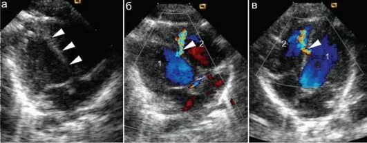 Аневризма перегородки у ребенка. Дефект межпредсердной перегородки УЗИ сердца. УЗИ сердца, аневризма межпредсердной перегородки.