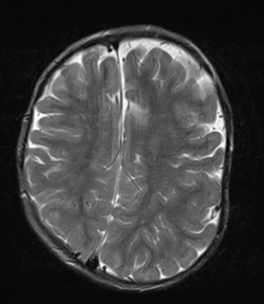 Лейкоэнцефалит