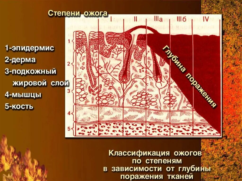 Ожог 2 степени степень тяжести. Классификация ожогов по степени тяжести. Классификация ожогов по глубине поражения тканей. Степени поражения при ожогах. Степени ожогов по глубине поражения кожи и тканей.