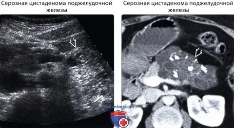 Поджелудочная железа кистозно солидное образование