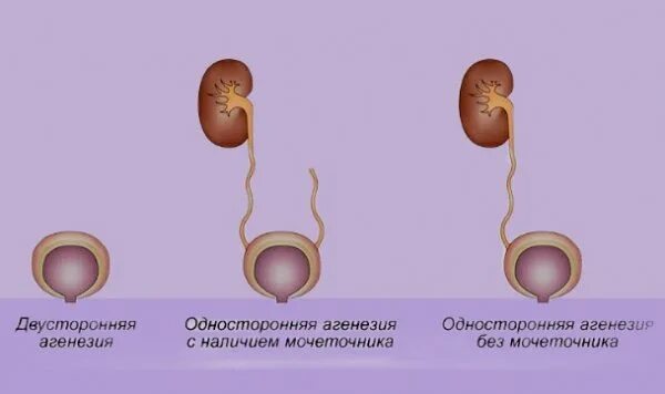 Лечение аплазии