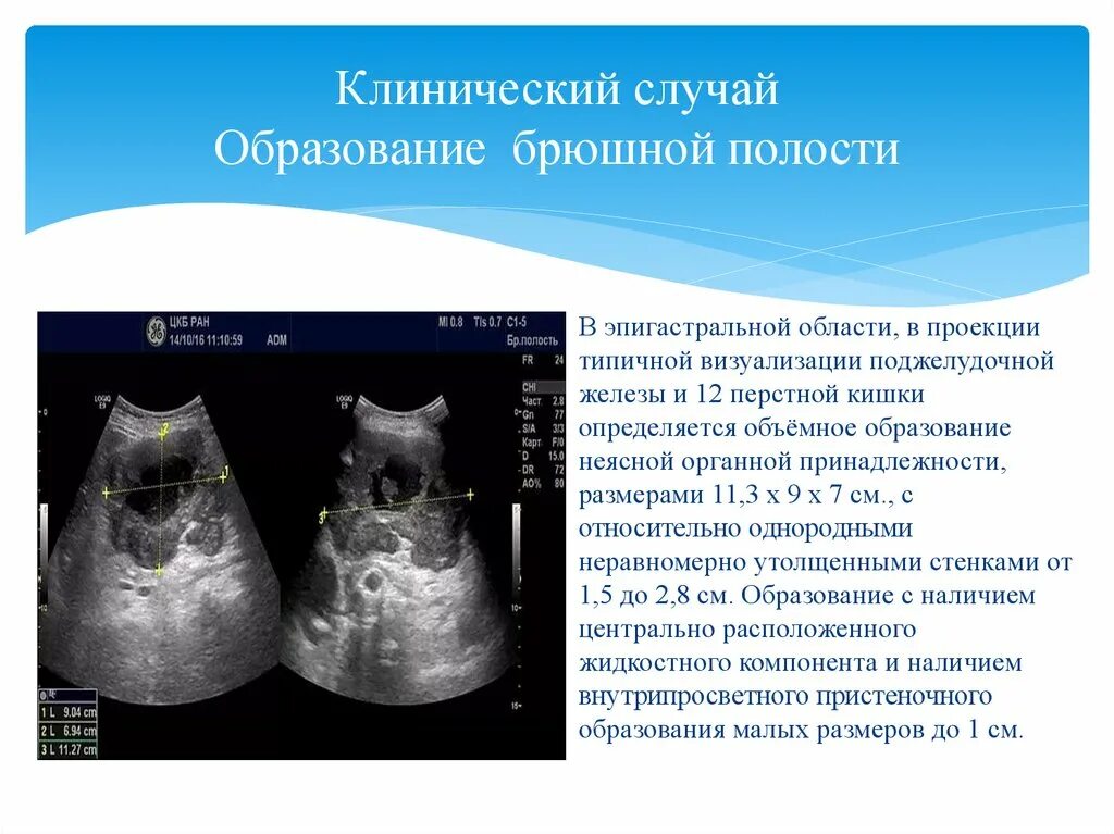 Узи брюшной полости что можно есть. УЗИ брюшной полости. Объемное образование брюшной полости.