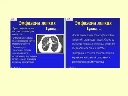 Эмфизема легких буллы