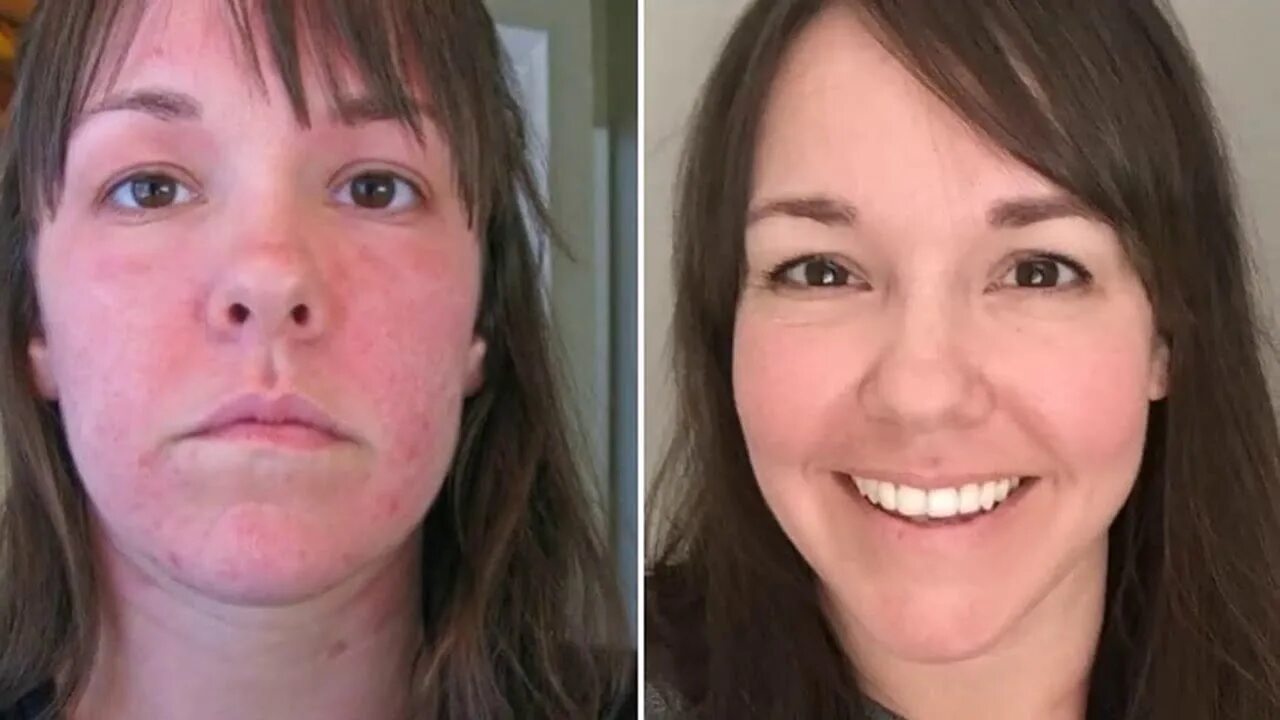 Кожа при гипотиреозе. Люди с проблемной щитовидкой. Лицо женщины с гипотиреозом. Гипотиреоз лицо до и после.