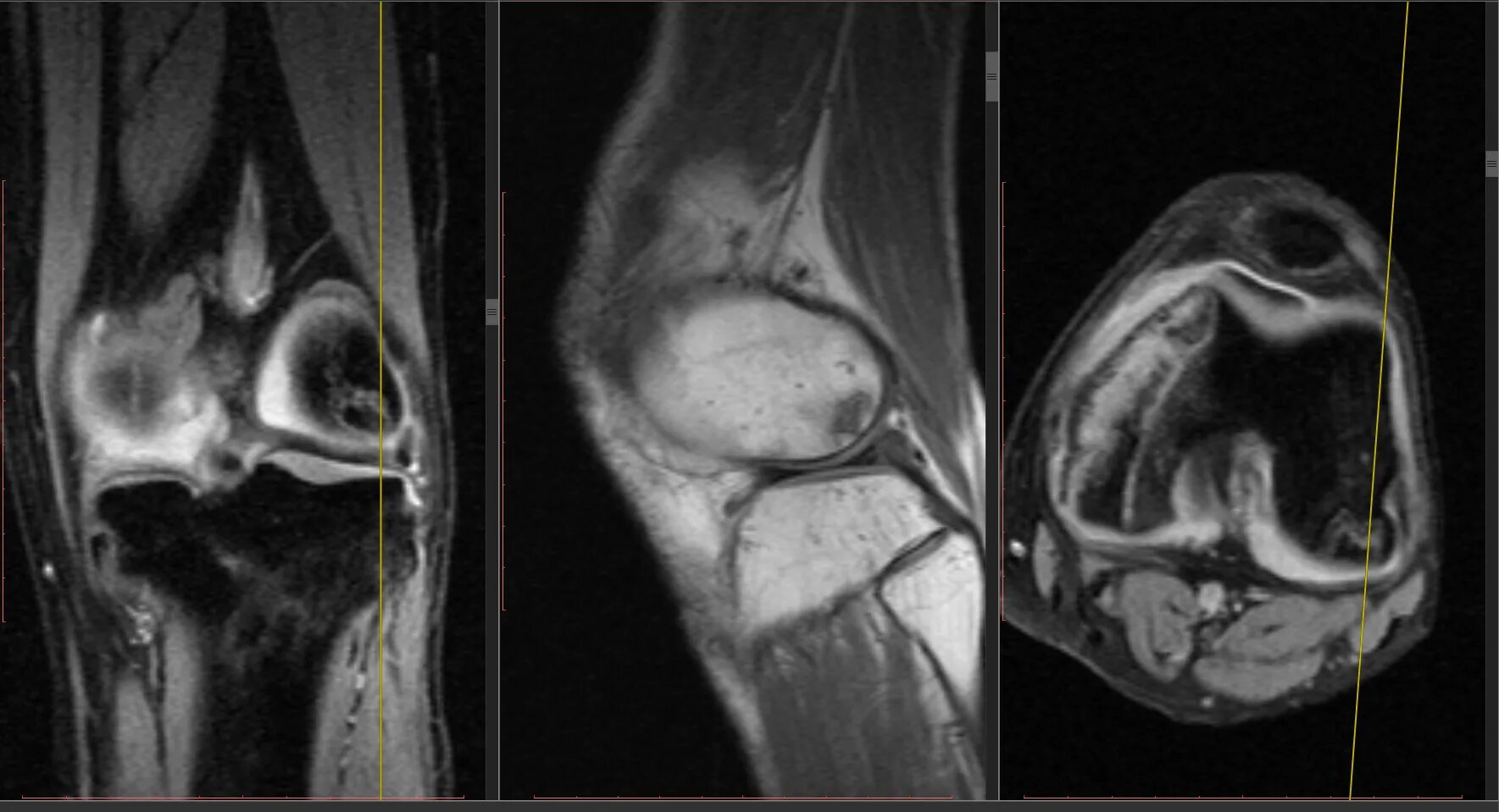 Мрт исследование коленного сустава. Магнитно-резонансная томография коленного сустава. Сагиттальная проекция мрт коленный сустав. Аксил коленный сустав мрт.