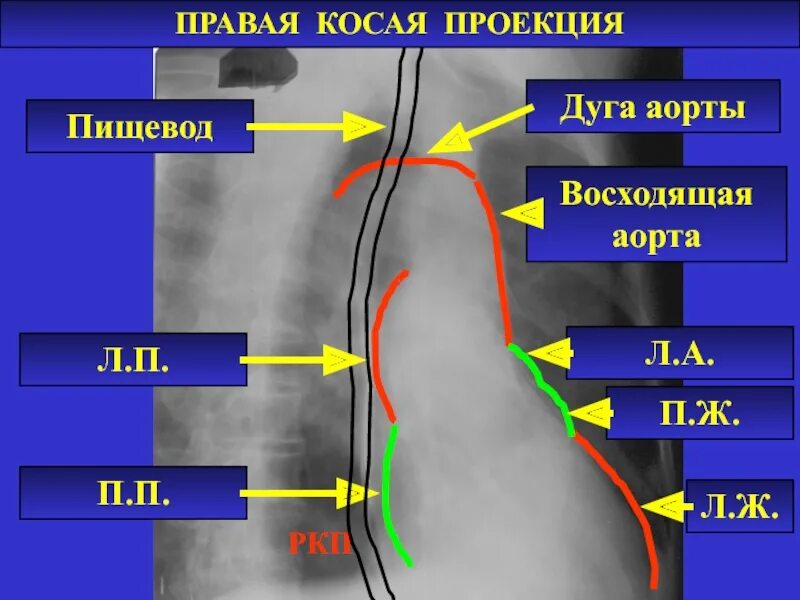 Первая косая проекция рентген. Правая косая проекция сердца. Рентген сердца в правой косой проекции. Снимок сердца первая косая проекция.