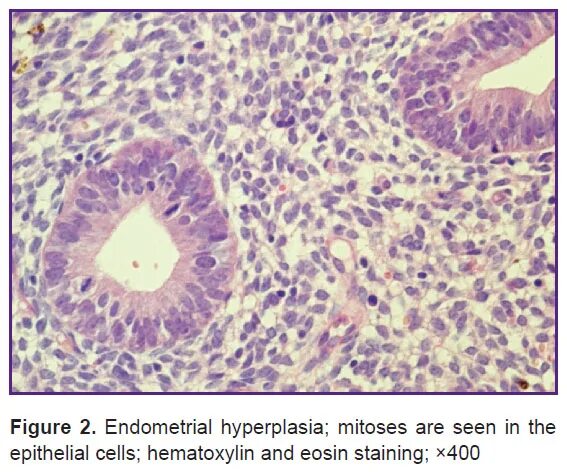 Простая атипия эндометрия. Гиперплазия эндометрия микроскопия. Гиперплазия эндометрия митозы. Что такое очаговая гиперплазия железистого эпителия. Гиперплазия эндометрия без атипии микропрепарат.