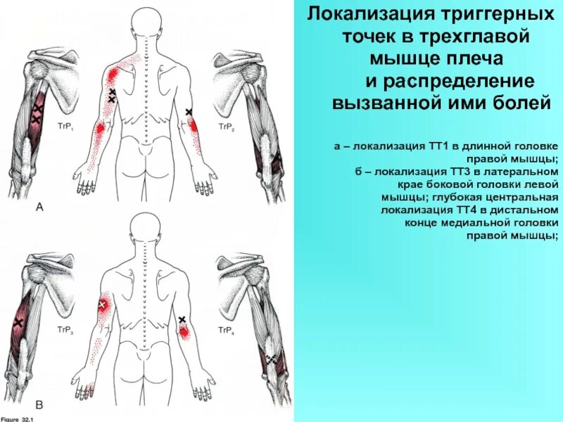 Триггерные точки мышц плечевого пояса. Триггерная точка в мышцах. Болит плечо триггерные точки. Локализация триггерных точек. Триггерные точки это простыми словами