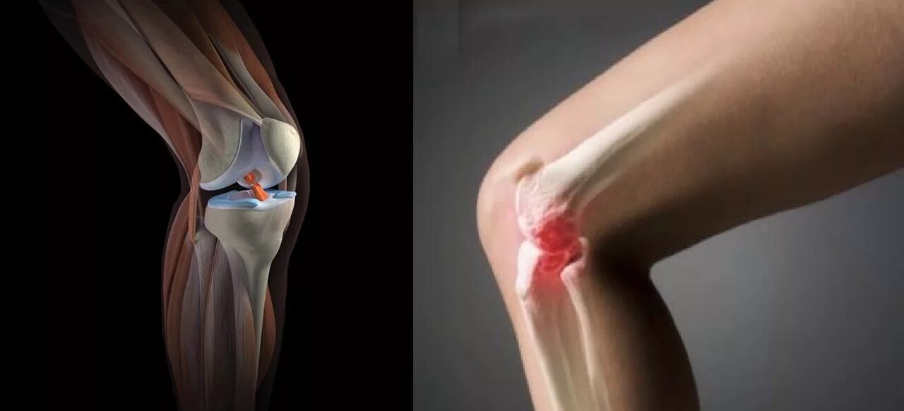 Травма связок сустава. Дисторсия коленного сустава. Травма разрыв крестообразной связки коленного сустава. Синовит коленного сустава рентген. Разрыв крестообразной связки коленного сустава рентген.