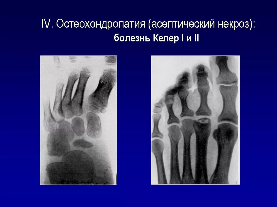 Болезнь келлера стопы. Остеохондропатия Келлера 2. Остеохондропатия головки 1 плюсневой кости. Келлер 1 и остеохондропатия. Болезнь Келлера 2 рентген.