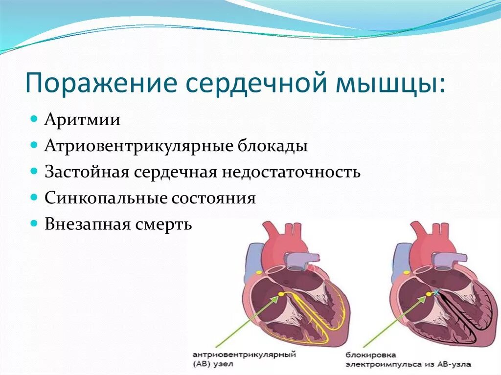 Заболевания мышц сердца. Поражение сердечной мышцы. растяжение сердечной мышцы. синдром поражения мышцы сердца. ослабление сердечной мышцы.