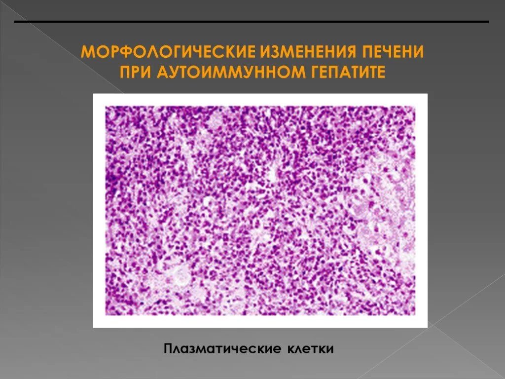 Аутоиммунная печени. Аутоиммунный гепатит микропрепараты. Аутоиммунный гепатит микропрепарат. Аутоиммунный гепатит гистологическая картина. Аутоиммунный гепатит печени микропрепарат.