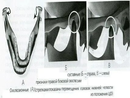 Окклюзия слева