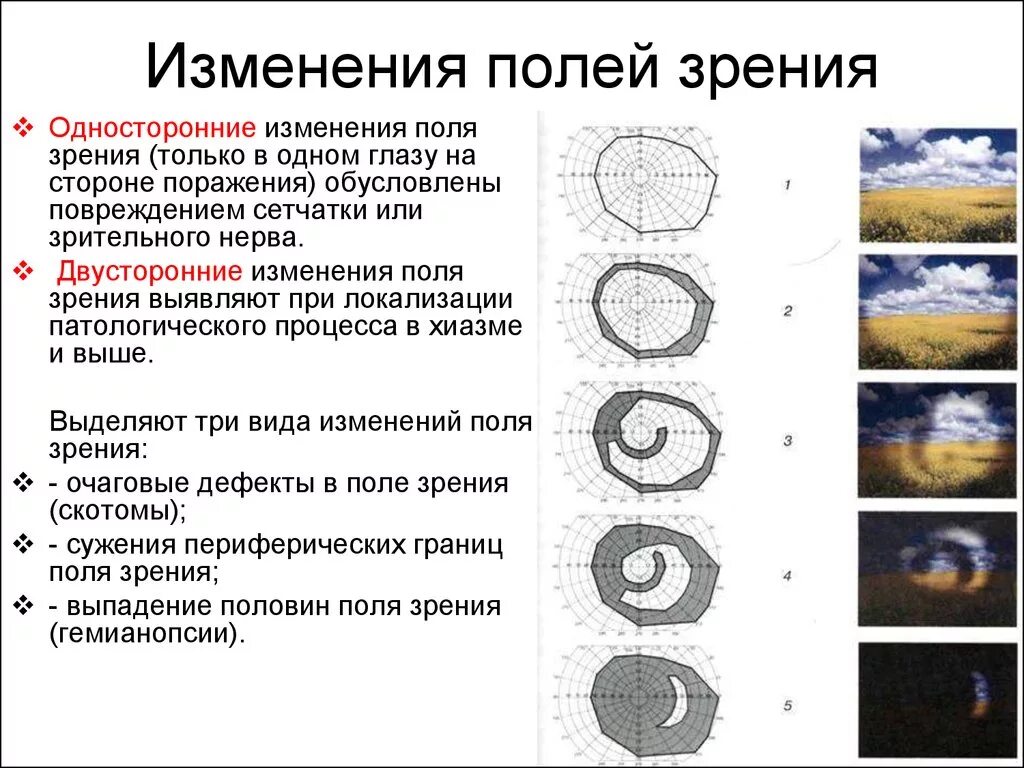 Поле зрения. Выпадения поля зрения.. Выпадение периферических полей зрения. Выпадение полей зрения причины неврология. Описание выпадения полей зрения. Почему меняется в разные