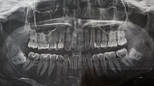Ки б 8. Ретинированные восьмерки рентген.