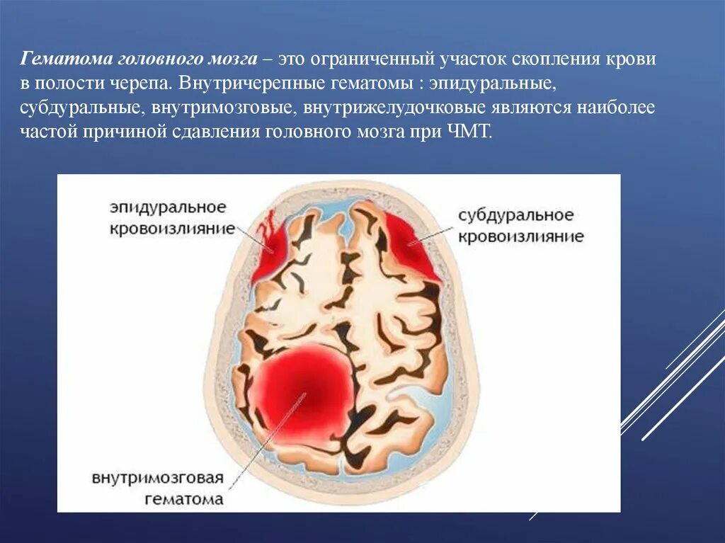 Внутрижелудочковая гематома головного мозга. Классификация субдуральной гематом головного мозга. Эпидуральное кровоизлияние. Гематома и кровоизлияние.