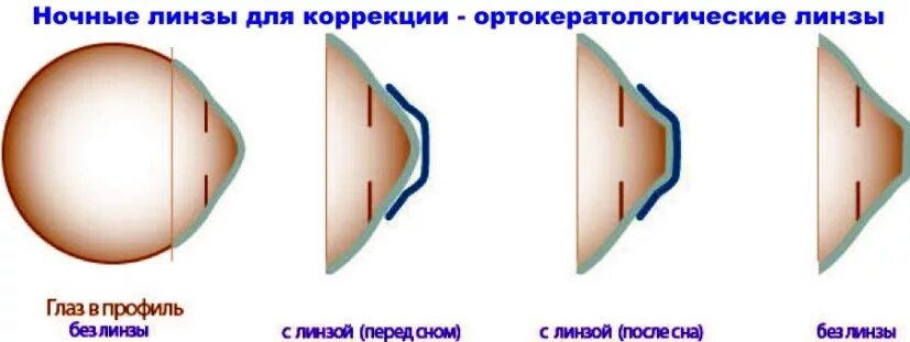 Ортокератологические линзы для детей. Ночные линзы. Ночные контактные линзы для коррекции зрения. Ортокератология ночные линзы. Можно в линзах спать час