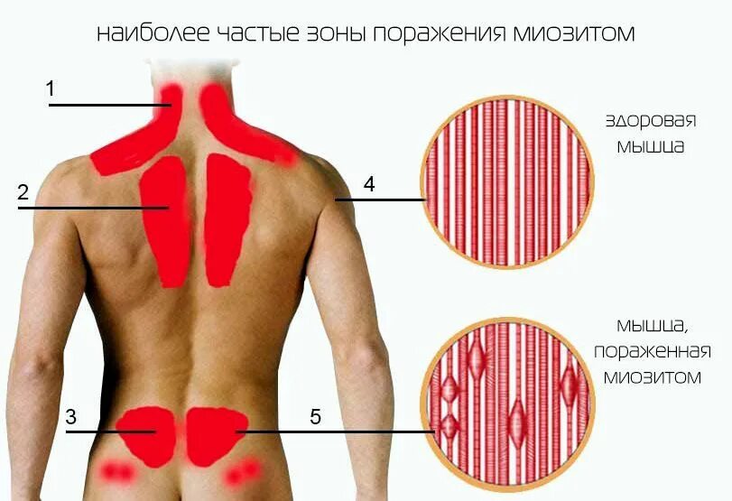 Болит спина в области лопаток причины. Воспаление мышц поясницы.