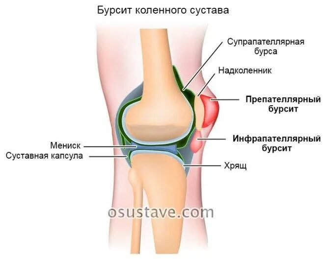 Боль под коленом спереди