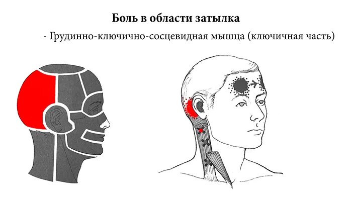 Боли в затылочной части головы и шеи. Боль в затылке головы. Болит задняя часть головы. Причины головной боли. Головная боль локализация.