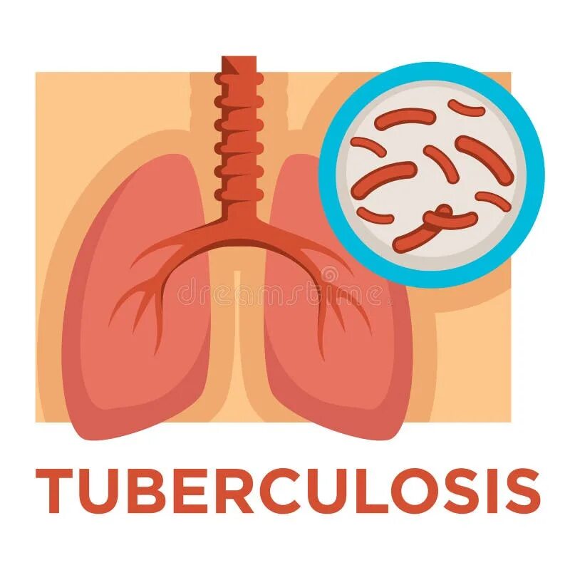 Tuberculosis disease. Tuberculosis disease. Tuberculosis disease. Открытая форма туберкулеза. Микобактериум туберкулезис.