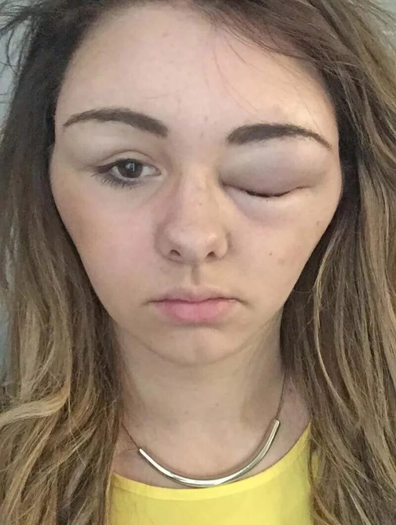 Реакция на татуаж бровей. Аллергия на краску для воло. Реакция на краску для волос. Аллергия после покраски. Аллергическая реакция на краску для волос.