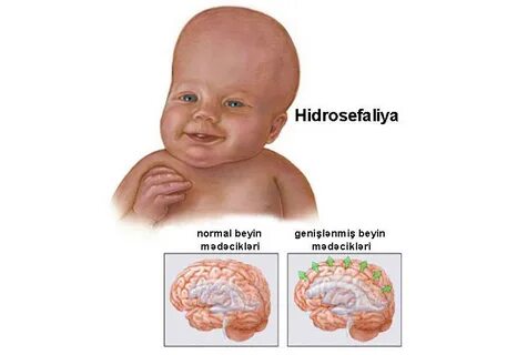Ребенка внутренняя гидроцефалия