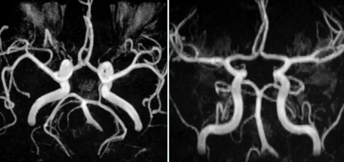 Виллизиев круг на кт ангиографии. Виллизиев круг ангиография. Виллизиев круг мрт. Трифуркация мрт.