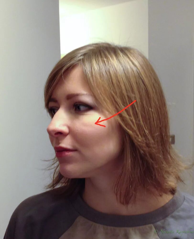 гиперпигментация мелазма. малярные мешки под глазами на скулах. периорбитальная розацеа. на лице появились полоски. гиперпигментация хлоазма.