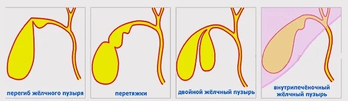 Изогнутая форма желчного пузыря. Аномалия формы желчного пузыря Перегиб. Врожденная патология желчного пузыря. Фиксированный Перегиб желчного пузыря.