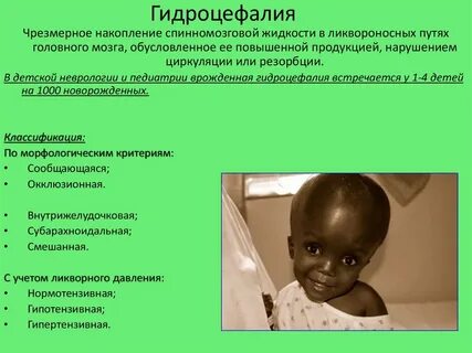 Гидроцефалия у взрослых