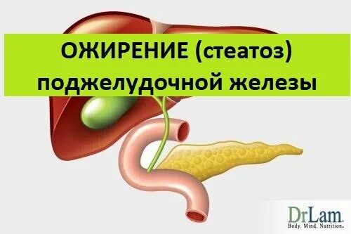 Ожирение поджелудочной железы. Стеатоз поджелудочной. Поджелудочная железа человека. Липоматоз поджелудочной железы.