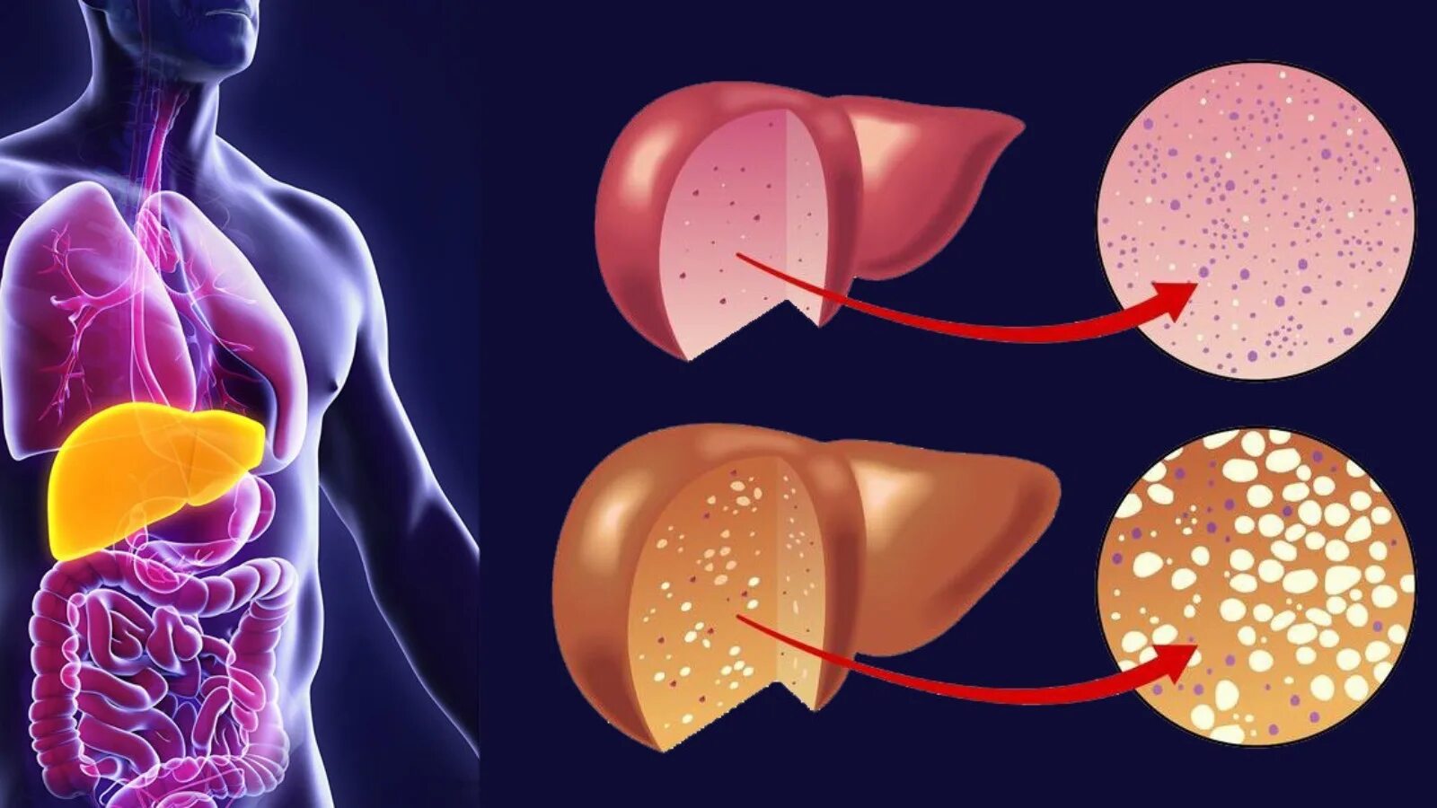 Печень в организме в жире. Болезнь печени жировой гепатоз. Неалкогольный жировой гепатоз. Жировой гепатоз – жировая болезнь печени. НАЖБП . Жировой гепатоз.