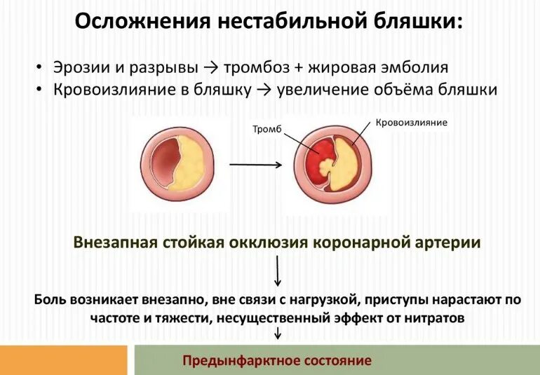 Предынфарктное состояние человека. Нестабильная атеросклеротическая бляшка. предынфарктное состояние симптомы. осложнения стенокардии. осложнения нестабильной атеросклеротической бляшки.