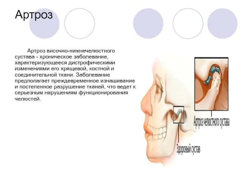 При открытии рта болит ухо. Артроз ВНЧС степени 1 рентген. Аксиографическое исследование ВНЧС. Деформирующий артрит ВНЧС.