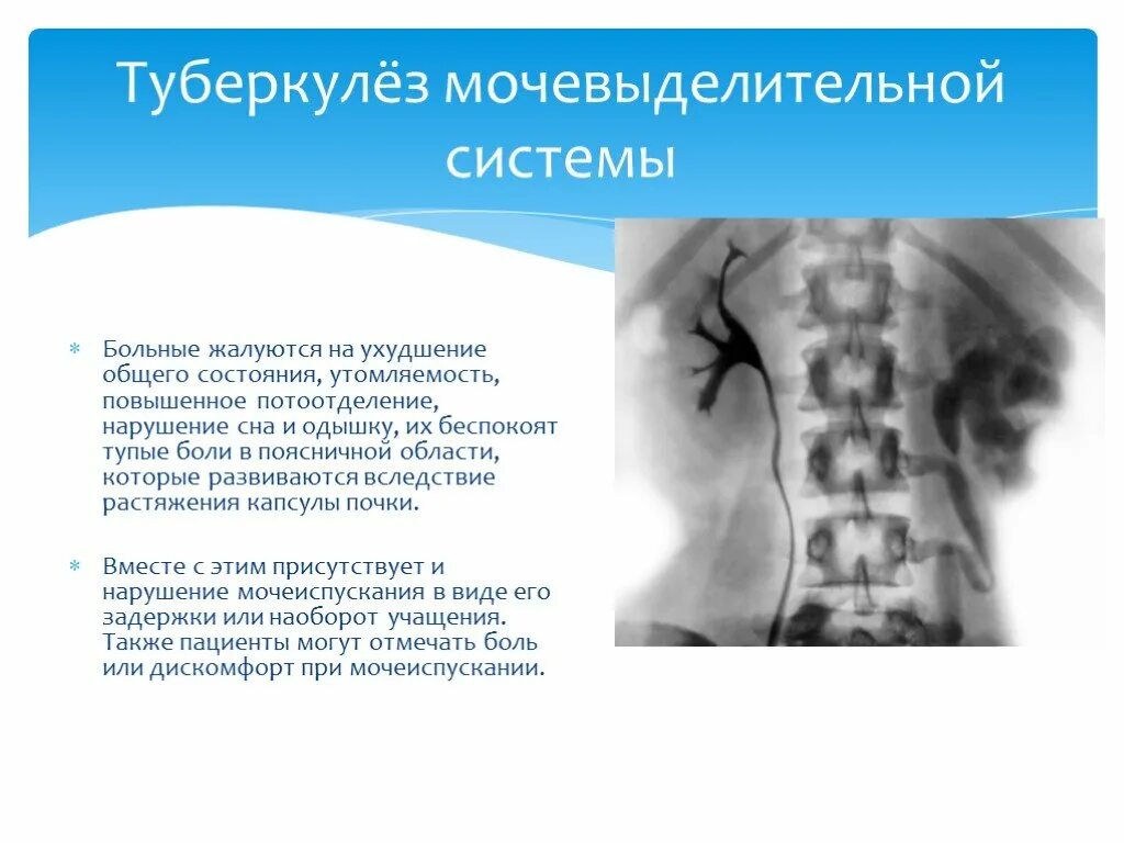 Внелегочный туберкулез. Внелегочные формы туберкулеза. Туберкулез мочевыдел системы.